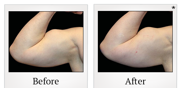 Before and After Photo 78 of Emsculpt® treatment at SF Bay Cosmetic Surgery Medical Group in San Ramon