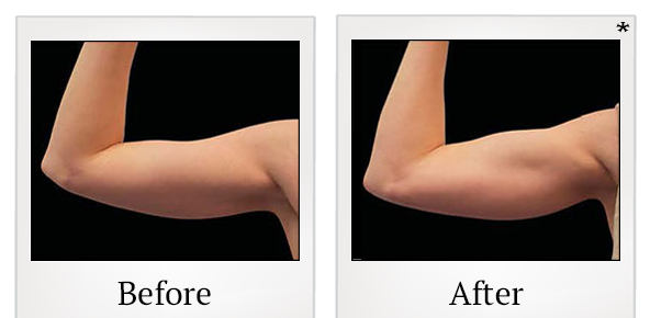 Before and After Photo 79 of Emsculpt® treatment at SF Bay Cosmetic Surgery Medical Group in San Ramon