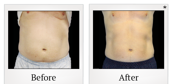 Before and After Photo 8 of Emsculpt® treatment at SF Bay Cosmetic Surgery Medical Group in San Ramon