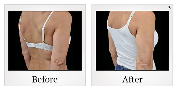 Before and After Photo 80 of Emsculpt® treatment at SF Bay Cosmetic Surgery Medical Group in San Ramon