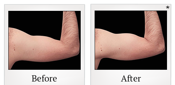 Before and After Photo 81 of Emsculpt® treatment at SF Bay Cosmetic Surgery Medical Group in San Ramon