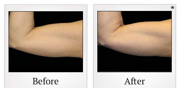 Before and After Photo 82 of Emsculpt® treatment at SF Bay Cosmetic Surgery Medical Group in San Ramon
