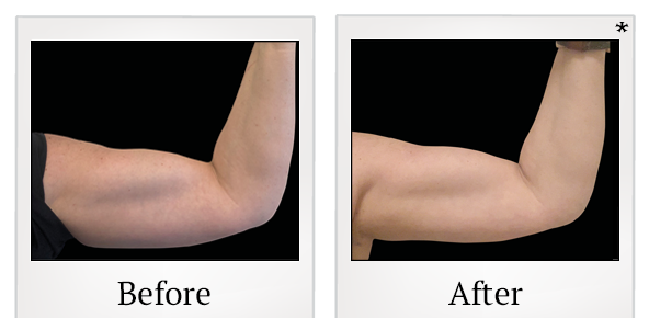 Before and After Photo 83 of Emsculpt® treatment at SF Bay Cosmetic Surgery Medical Group in San Ramon