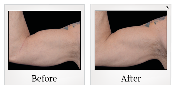 Before and After Photo 84 of Emsculpt® treatment at SF Bay Cosmetic Surgery Medical Group in San Ramon