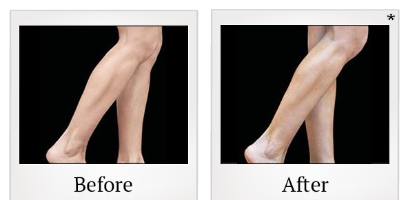 Before and After Photo 85 of Emsculpt® treatment at SF Bay Cosmetic Surgery Medical Group in San Ramon