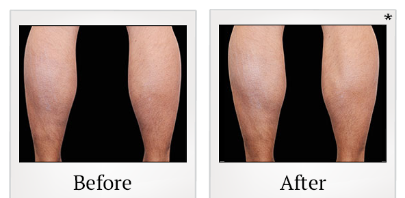 Before and After Photo 86 of Emsculpt® treatment at SF Bay Cosmetic Surgery Medical Group in San Ramon