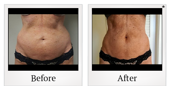 Before and After Photo 87 of Emsculpt® treatment at SF Bay Cosmetic Surgery Medical Group in San Ramon