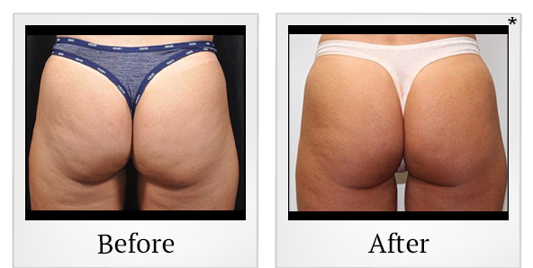 Before and After Photo 88 of Emsculpt® treatment at SF Bay Cosmetic Surgery Medical Group in San Ramon