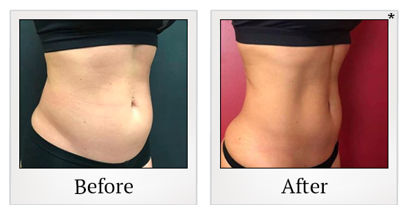 Before and After Photo 89 of Emsculpt® treatment at SF Bay Cosmetic Surgery Medical Group in San Ramon