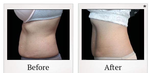 Before and After Photo 9 of Emsculpt® treatment at SF Bay Cosmetic Surgery Medical Group in San Ramon