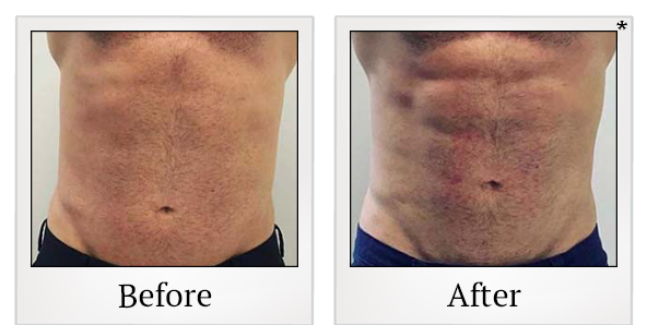 Before and After Photo 90 of Emsculpt® treatment at SF Bay Cosmetic Surgery Medical Group in San Ramon