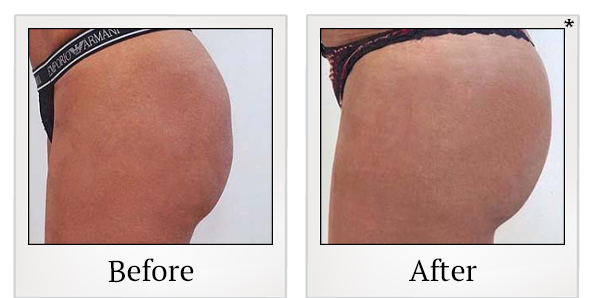 Before and After Photo 91 of Emsculpt® treatment at SF Bay Cosmetic Surgery Medical Group in San Ramon
