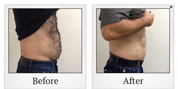 Before and After Photo 92 of Emsculpt® treatment at SF Bay Cosmetic Surgery Medical Group in San Ramon