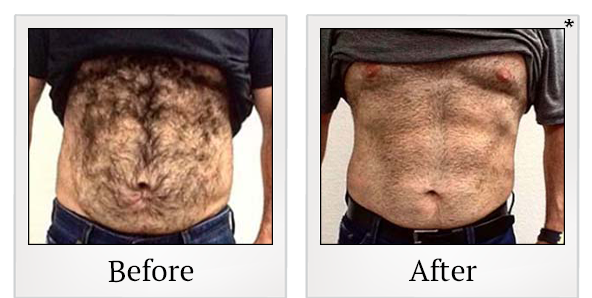 Before and After Photo 93 of Emsculpt® treatment at SF Bay Cosmetic Surgery Medical Group in San Ramon