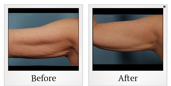Before and After Photo 1 of Exilis Ultra 360™ treatment at SF Bay Cosmetic Surgery Medical Group in San Ramon
