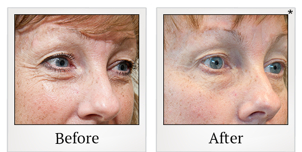 Before and After Photo 10 of Exilis Ultra 360™ treatment at SF Bay Cosmetic Surgery Medical Group in San Ramon