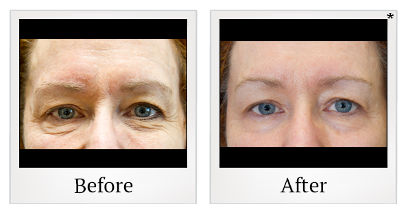Before and After Photo 11 of Exilis Ultra 360™ treatment at SF Bay Cosmetic Surgery Medical Group in San Ramon