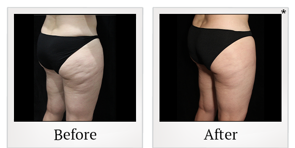 Before and After Photo 12 of Exilis Ultra 360™ treatment at SF Bay Cosmetic Surgery Medical Group in San Ramon