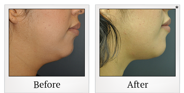 Before and After Photo 13 of Exilis Ultra 360™ treatment at SF Bay Cosmetic Surgery Medical Group in San Ramon