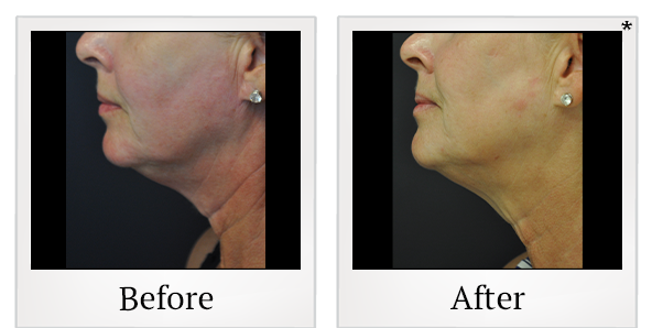 Before and After Photo 14 of Exilis Ultra 360™ treatment at SF Bay Cosmetic Surgery Medical Group in San Ramon