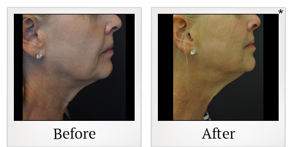 Before and After Photo 15 of Exilis Ultra 360™ treatment at SF Bay Cosmetic Surgery Medical Group in San Ramon
