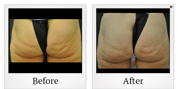 Before and After Photo 16 of Exilis Ultra 360™ treatment at SF Bay Cosmetic Surgery Medical Group in San Ramon