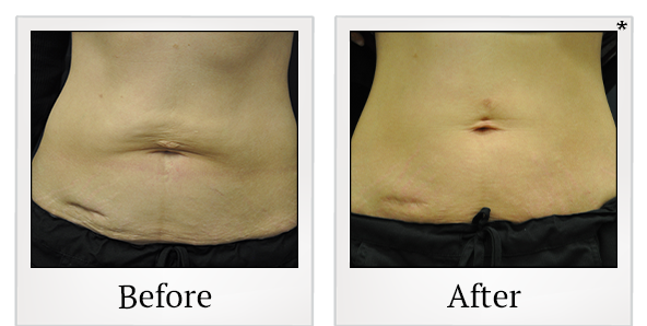 Before and After Photo 17 of Exilis Ultra 360™ treatment at SF Bay Cosmetic Surgery Medical Group in San Ramon