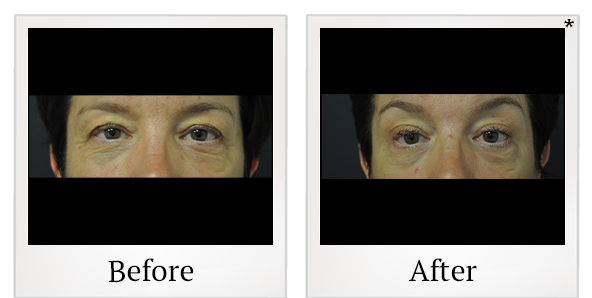 Before and After Photo 18 of Exilis Ultra 360™ treatment at SF Bay Cosmetic Surgery Medical Group in San Ramon