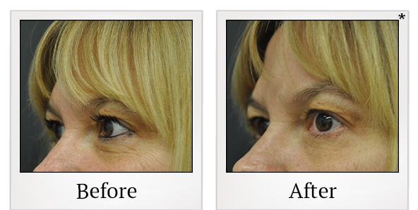 Before and After Photo 19 of Exilis Ultra 360™ treatment at SF Bay Cosmetic Surgery Medical Group in San Ramon