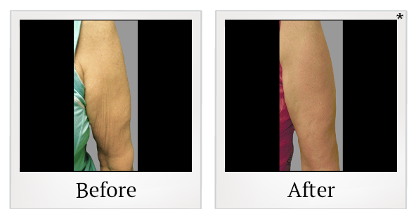 Before and After Photo 2 of Exilis Ultra 360™ treatment at SF Bay Cosmetic Surgery Medical Group in San Ramon