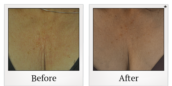 Before and After Photo 20 of Exilis Ultra 360™ treatment at SF Bay Cosmetic Surgery Medical Group in San Ramon