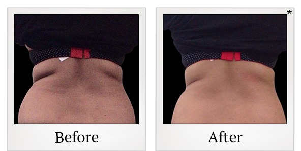 Before and After Photo 21 of Exilis Ultra 360™ treatment at SF Bay Cosmetic Surgery Medical Group in San Ramon