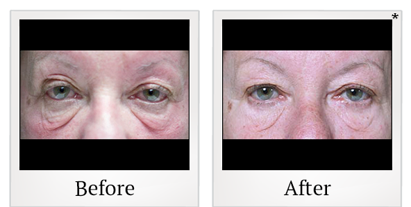 Before and After Photo 22 of Exilis Ultra 360™ treatment at SF Bay Cosmetic Surgery Medical Group in San Ramon