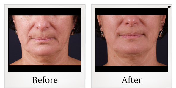 Before and After Photo 23 of Exilis Ultra 360™ treatment at SF Bay Cosmetic Surgery Medical Group in San Ramon