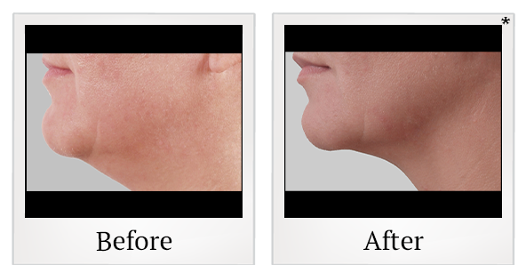 Before and After Photo 24 of Exilis Ultra 360™ treatment at SF Bay Cosmetic Surgery Medical Group in San Ramon