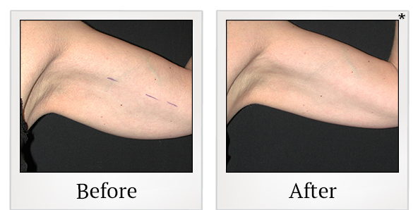 Before and After Photo 25 of Exilis Ultra 360™ treatment at SF Bay Cosmetic Surgery Medical Group in San Ramon