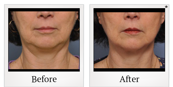 Before and After Photo 26 of Exilis Ultra 360™ treatment at SF Bay Cosmetic Surgery Medical Group in San Ramon