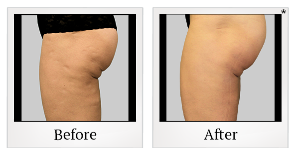 Before and After Photo 27 of Exilis Ultra 360™ treatment at SF Bay Cosmetic Surgery Medical Group in San Ramon