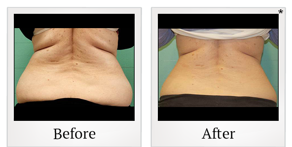 Before and After Photo 28 of Exilis Ultra 360™ treatment at SF Bay Cosmetic Surgery Medical Group in San Ramon
