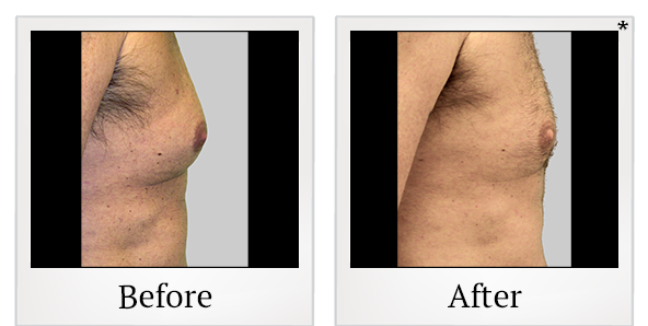 Before and After Photo 29 of Exilis Ultra 360™ treatment at SF Bay Cosmetic Surgery Medical Group in San Ramon