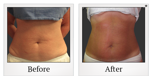 Before and After Photo 3 of Exilis Ultra 360™ treatment at SF Bay Cosmetic Surgery Medical Group in San Ramon