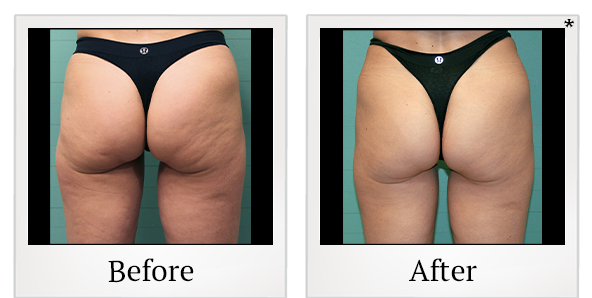 Before and After Photo 30 of Exilis Ultra 360™ treatment at SF Bay Cosmetic Surgery Medical Group in San Ramon