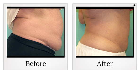 Before and After Photo 31 of Exilis Ultra 360™ treatment at SF Bay Cosmetic Surgery Medical Group in San Ramon