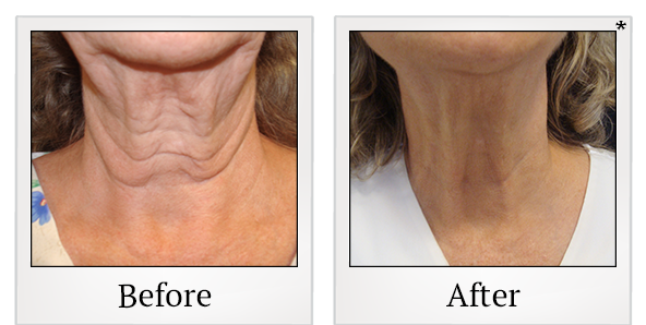 Before and After Photo 32 of Exilis Ultra 360™ treatment at SF Bay Cosmetic Surgery Medical Group in San Ramon