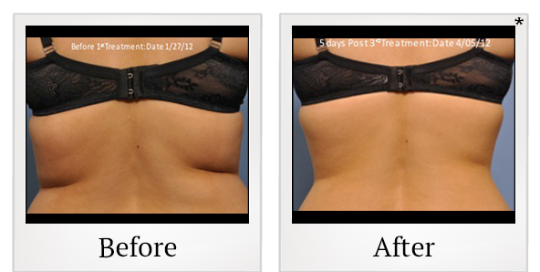Before and After Photo 33 of Exilis Ultra 360™ treatment at SF Bay Cosmetic Surgery Medical Group in San Ramon