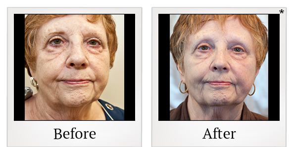 Before and After Photo 34 of Exilis Ultra 360™ treatment at SF Bay Cosmetic Surgery Medical Group in San Ramon