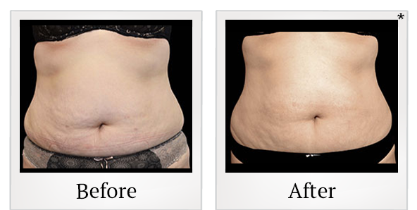 Before and After Photo 35 of Exilis Ultra 360™ treatment at SF Bay Cosmetic Surgery Medical Group in San Ramon