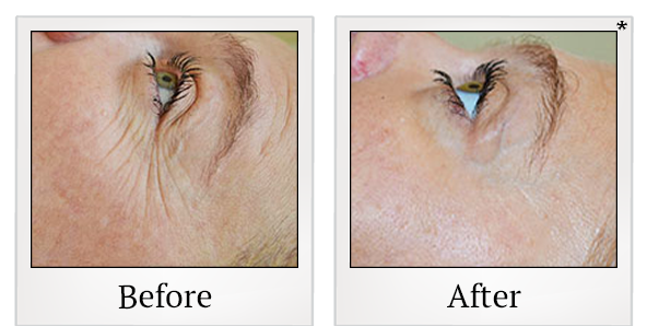 Before and After Photo 36 of Exilis Ultra 360™ treatment at SF Bay Cosmetic Surgery Medical Group in San Ramon