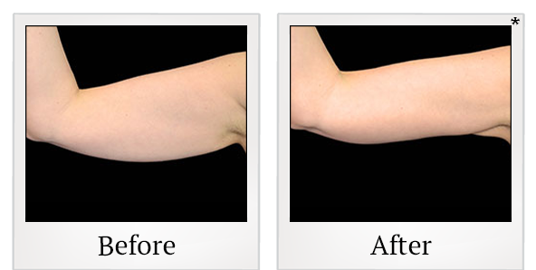 Before and After Photo 37 of Exilis Ultra 360™ treatment at SF Bay Cosmetic Surgery Medical Group in San Ramon