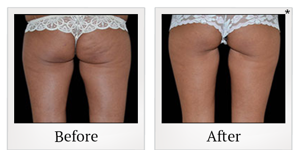 Before and After Photo 38 of Exilis Ultra 360™ treatment at SF Bay Cosmetic Surgery Medical Group in San Ramon